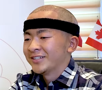 https://shokumou.net/wp-content/uploads/2022/04/university-student-transplanted-his-hair.png